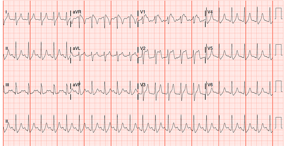 Cureus | ST-Segment Elevation in the Setting of Diabetic Ketoacidosis ...