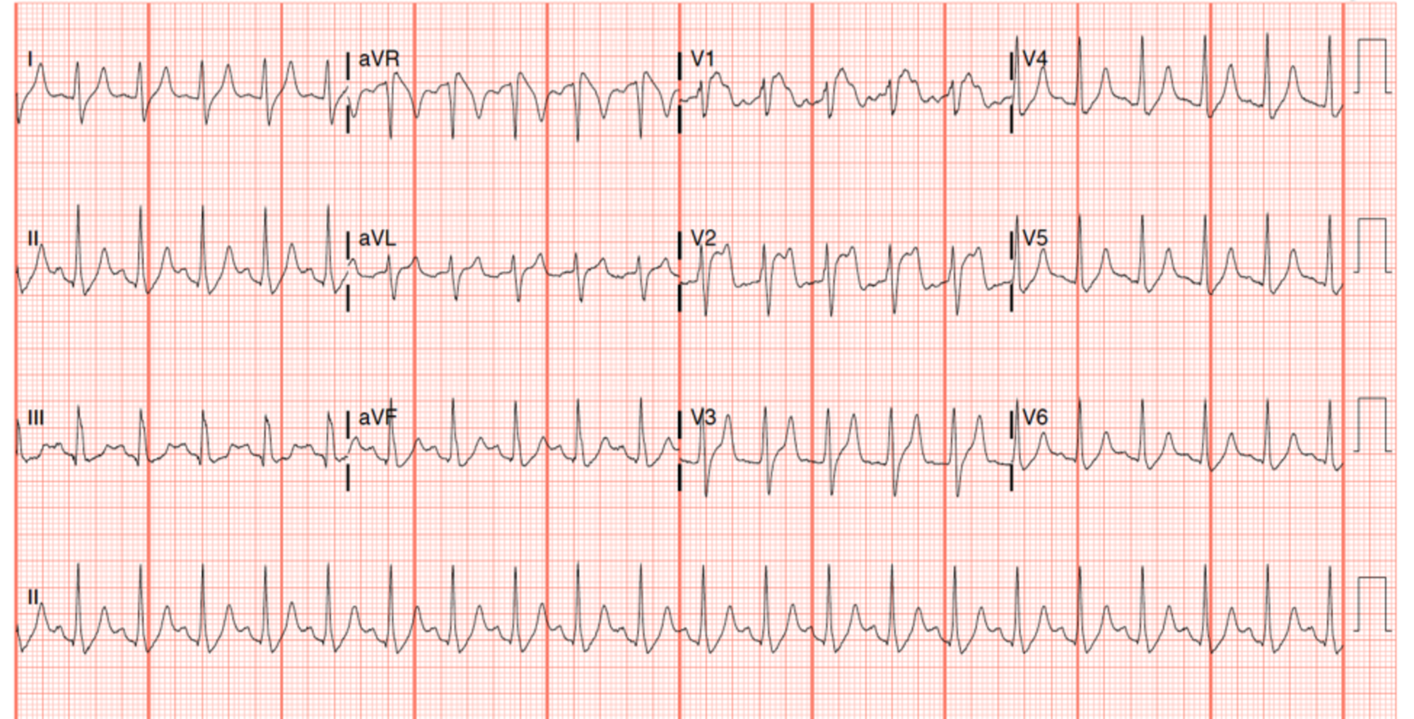 Cureus | ST-Segment Elevation in the Setting of Diabetic Ketoacidosis ...