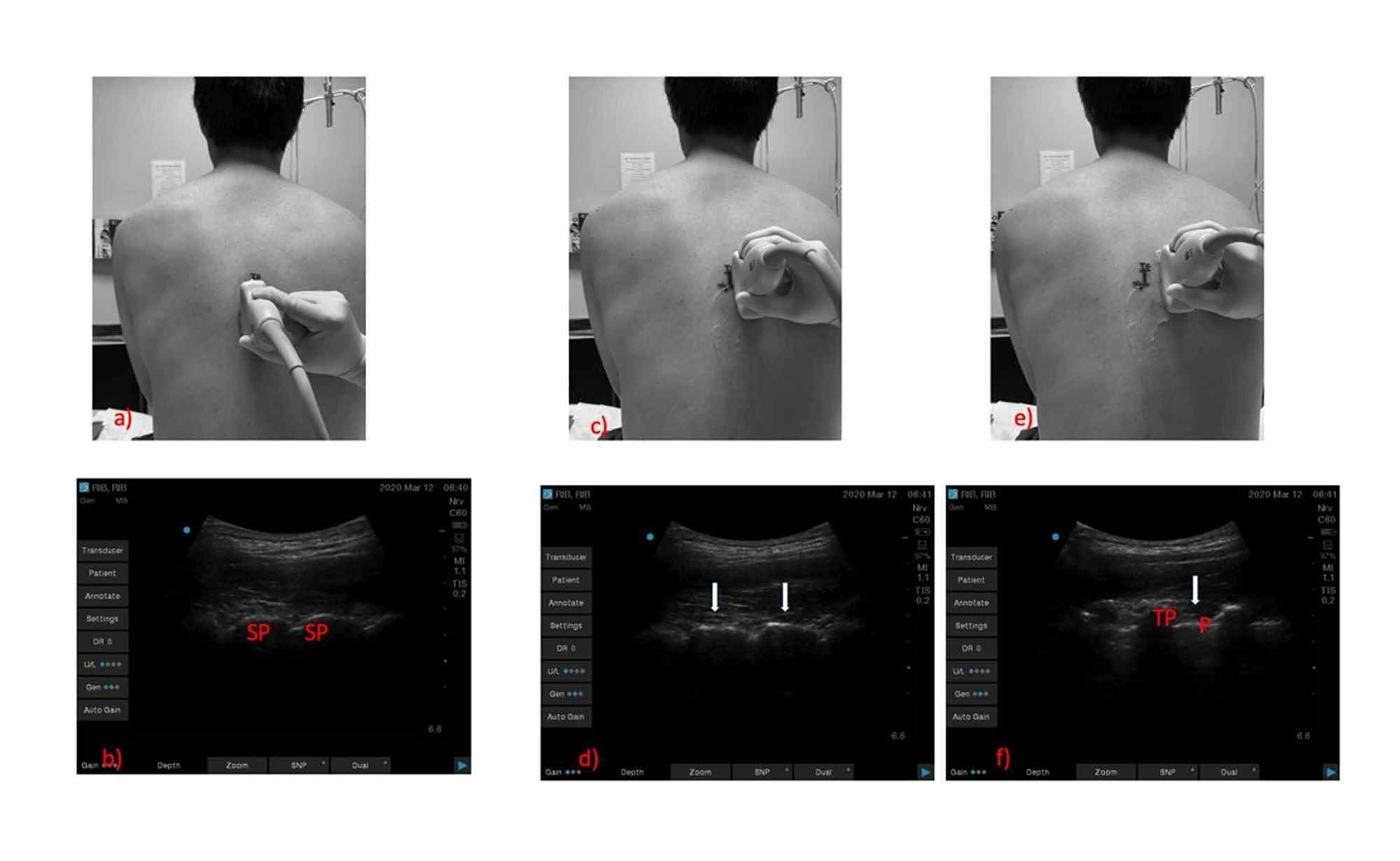 Cureus The Challenges of Ultrasoundguided Thoracic Paravertebral