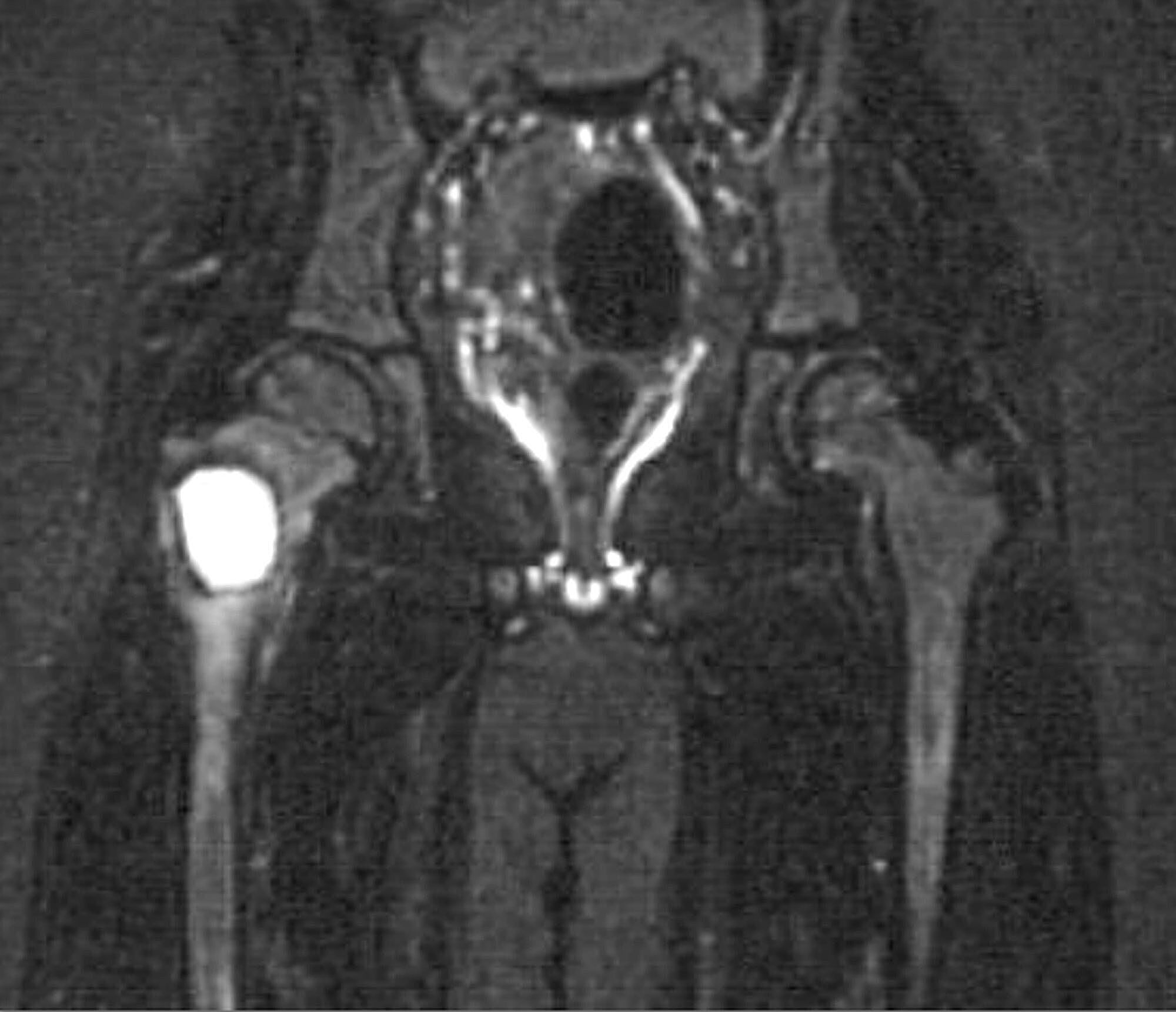 Cureus | Aneurysmal Bone Cyst of the Proximal Femur and Its Management ...