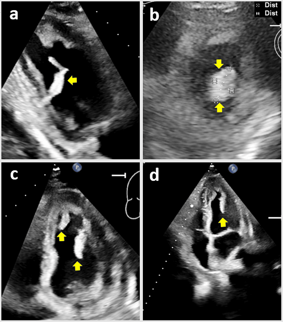 Cureus | Hypereosinophilia and Left Ventricular Thrombus: A Case Report and  Literature Review | Article