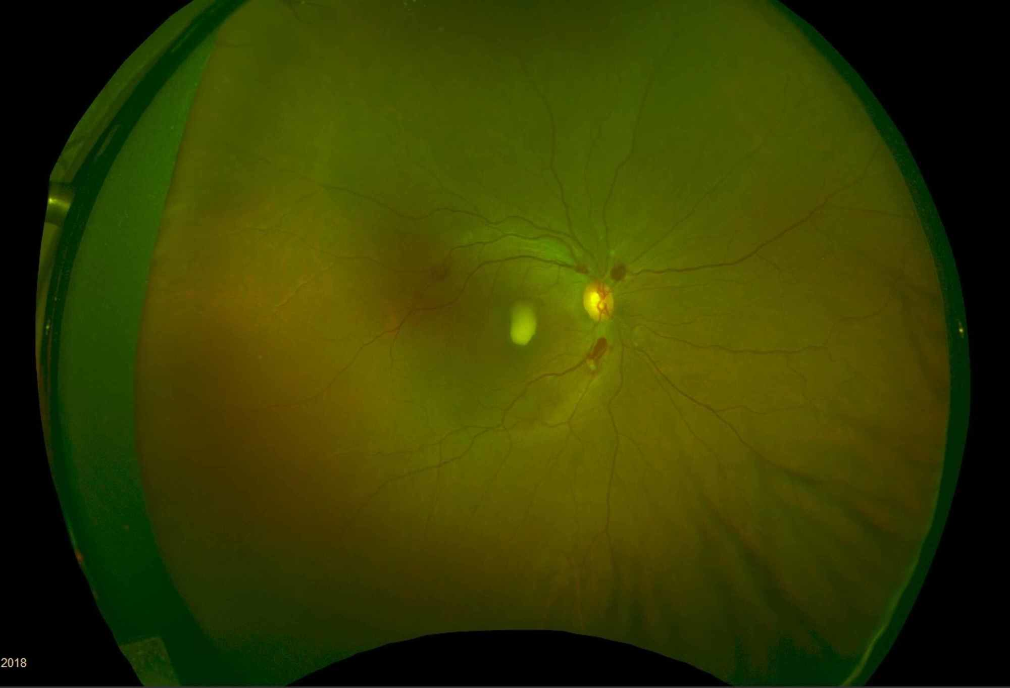 Cureus | A Case of Acute Promyelocytic Leukemia With Retinal ...