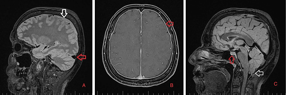 Brain-MRI-on-February-1,-2023. Brain-MRI-on-February-1,-2023.
