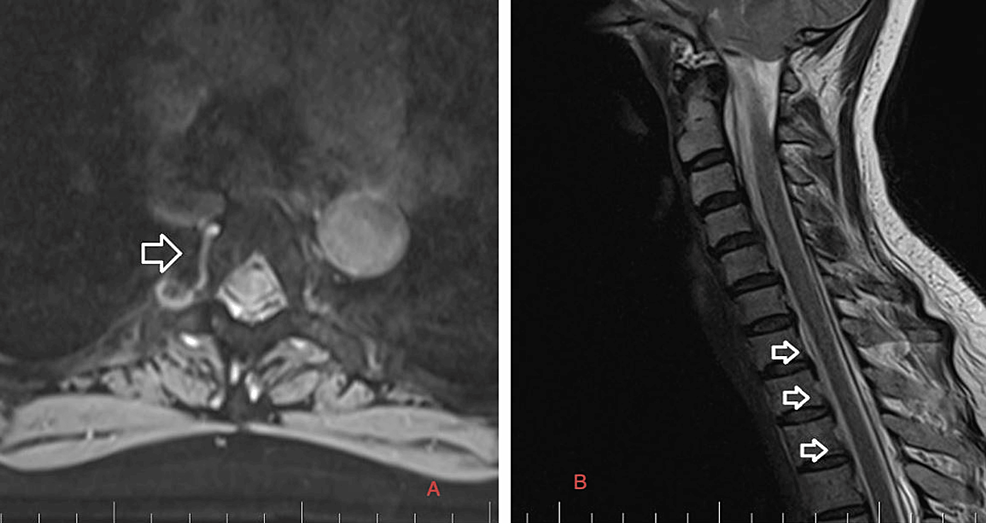 C-spine-MRI-on-February-2,-2023. C-spine-MRI-on-February-2,-2023.