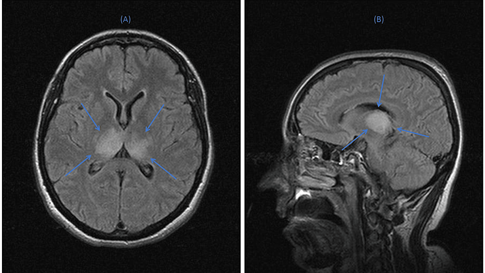 Brain-MRI-images-in-(A)-axial-and-(B)-sagittal-planes,-illustrating-bilateral-thalamic-infiltrates-(blue-arrows)