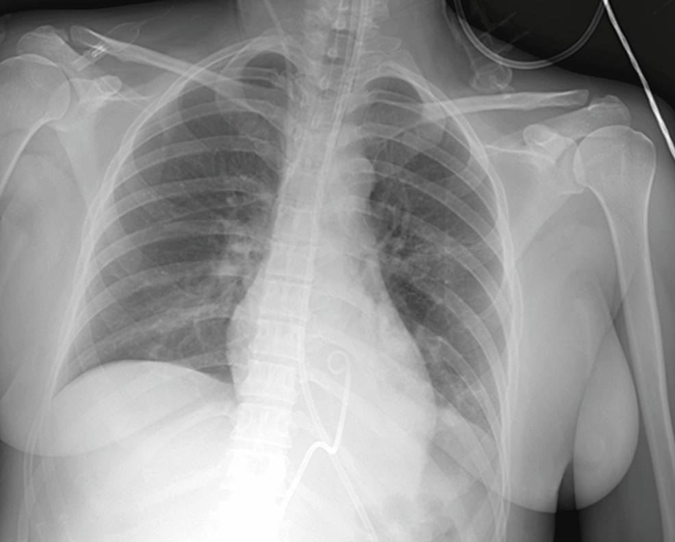 Chest-X-ray-showing-a-normal-cardiac-silhouette-with-the-catheter-positioned-in-the-pericardial-cavity-just-before-its-removal