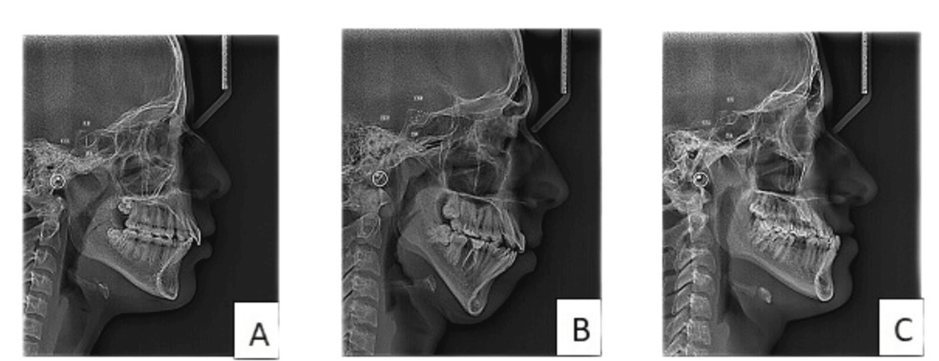 Morphology Of The Sella Turcica In Individuals With Different Skeletal 