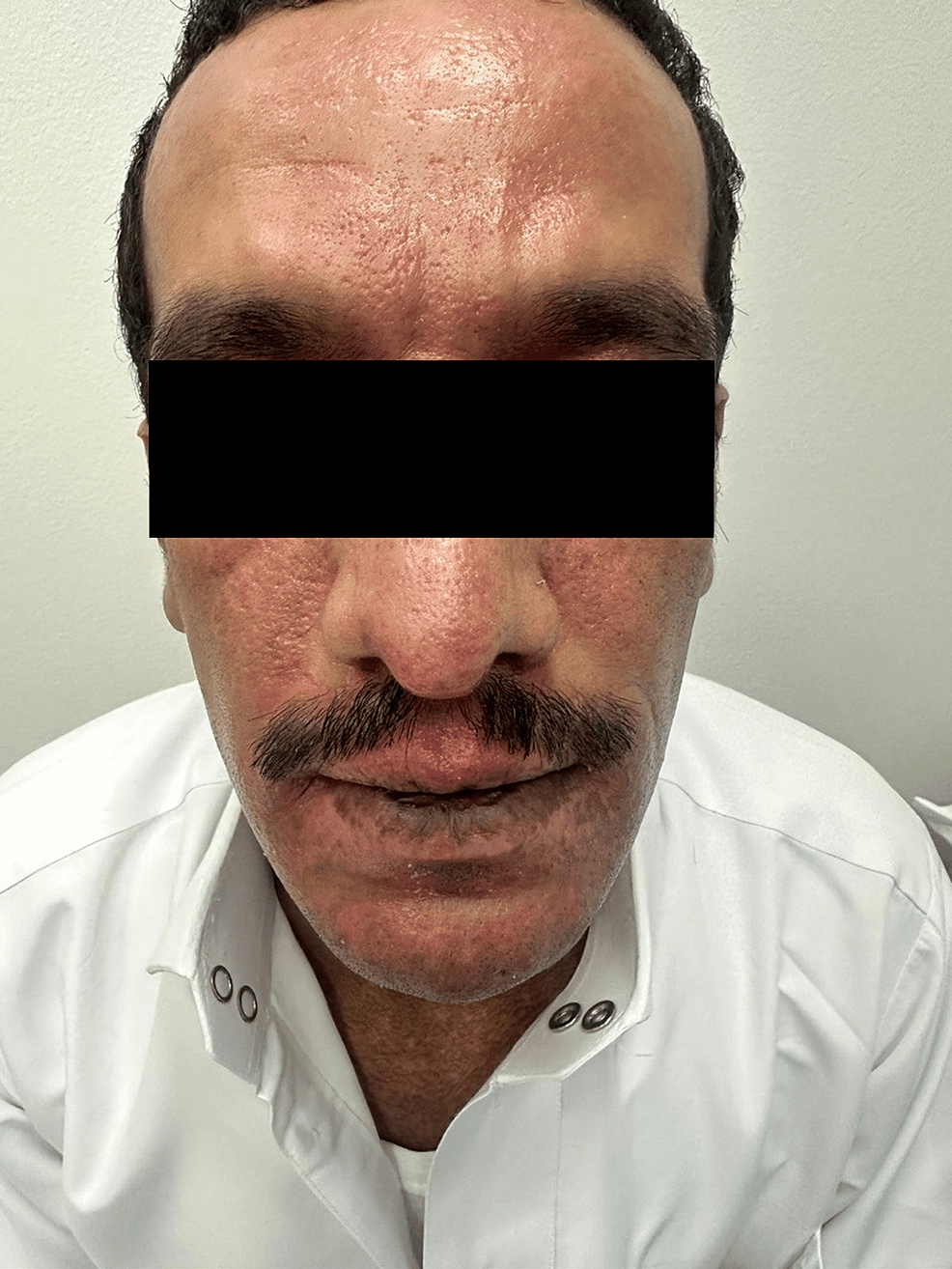 Cureus Concurrent Presentation of Eczema Herpeticum and Acute