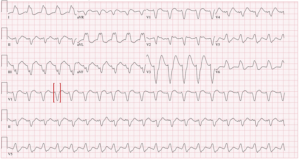 Cardiovascular Collapse Requiring Veno-Arterial Extracorporeal Membrane ...