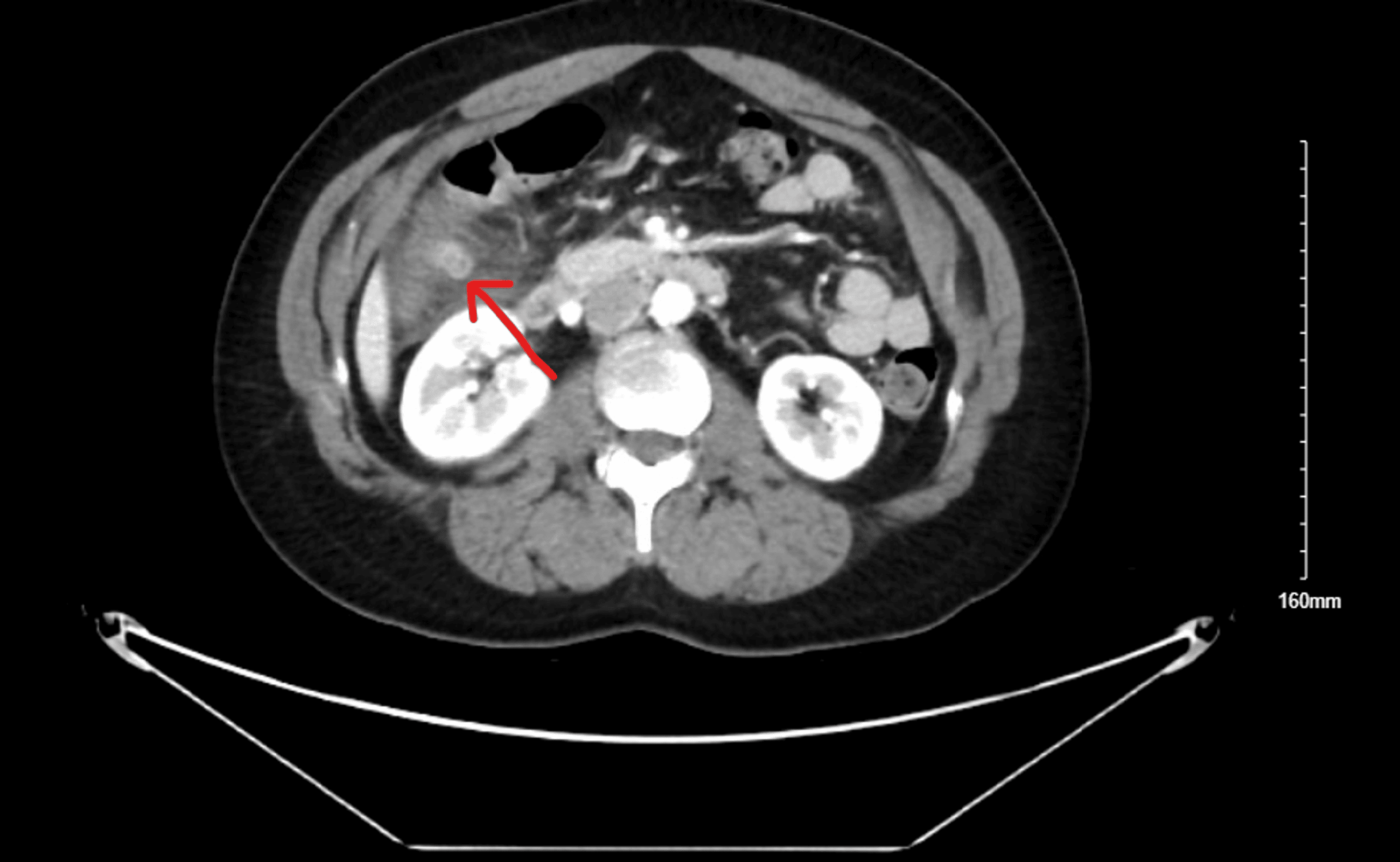 A Rare Presentation of Epiploic Appendagitis as Chest Pain A Case