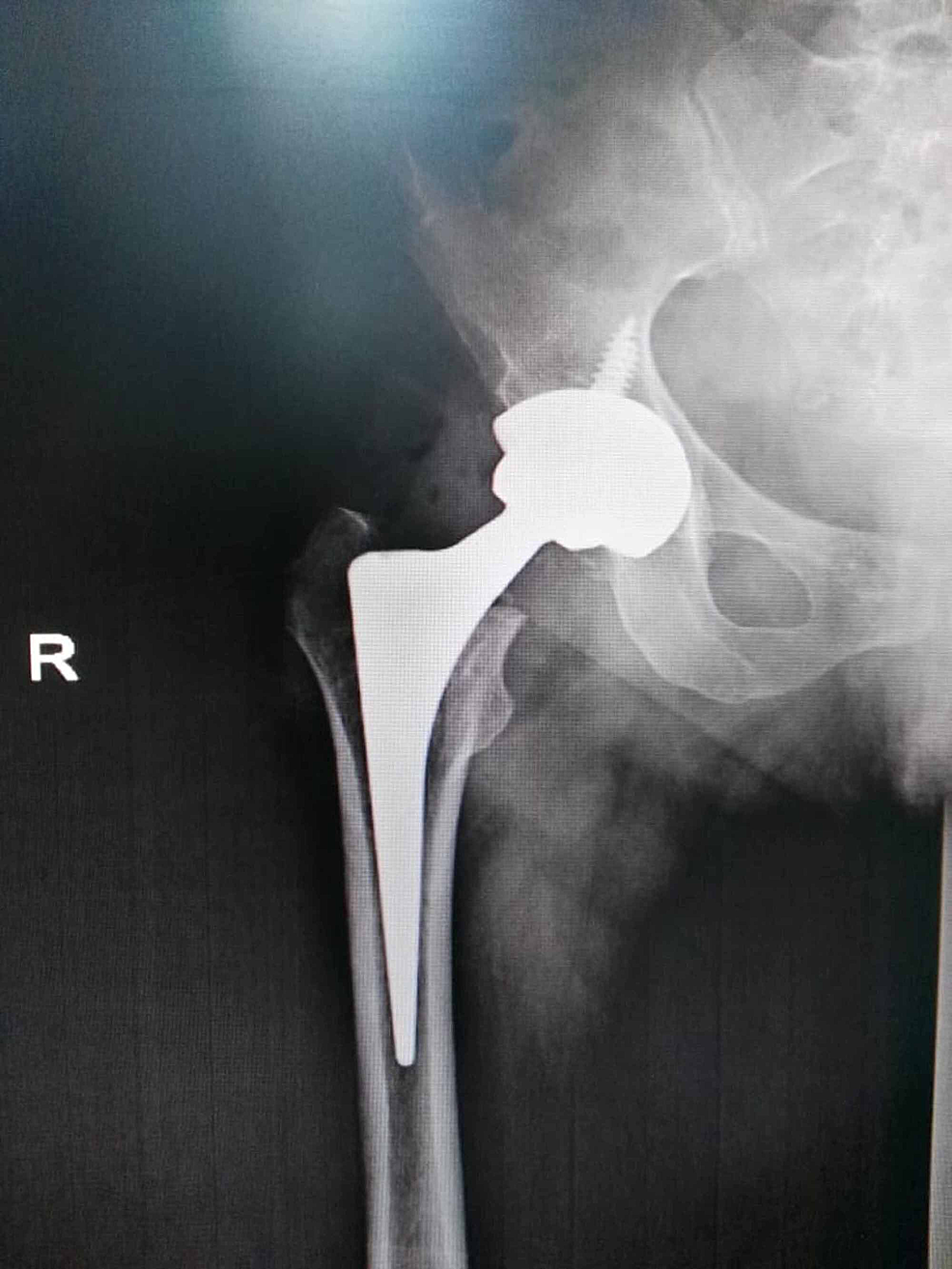 Cureus | Epidermolysis Bullosa: A Case of Successful Total Hip Arthroplasty