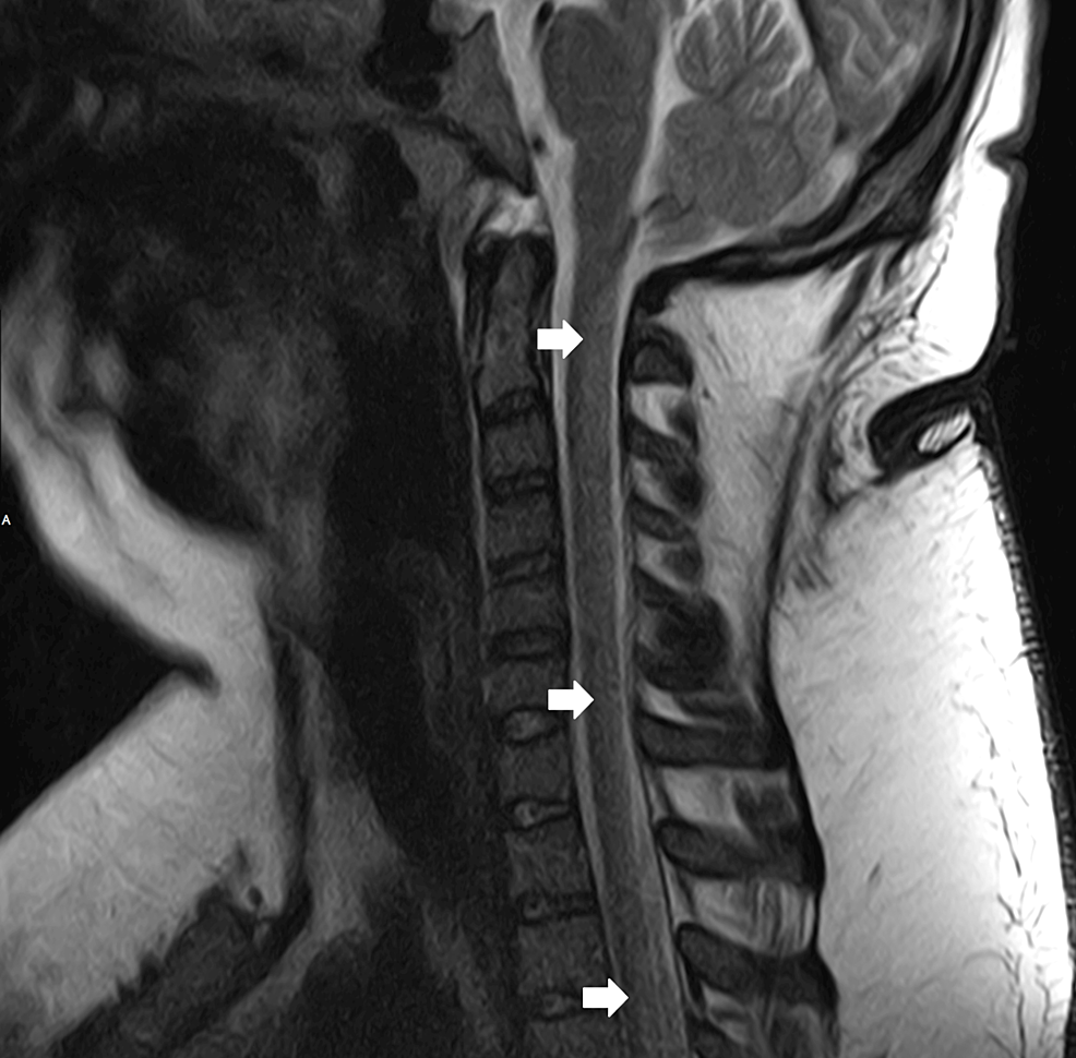Cureus Recreational Nitrous Oxide Causing Deep Vein Thrombosis and