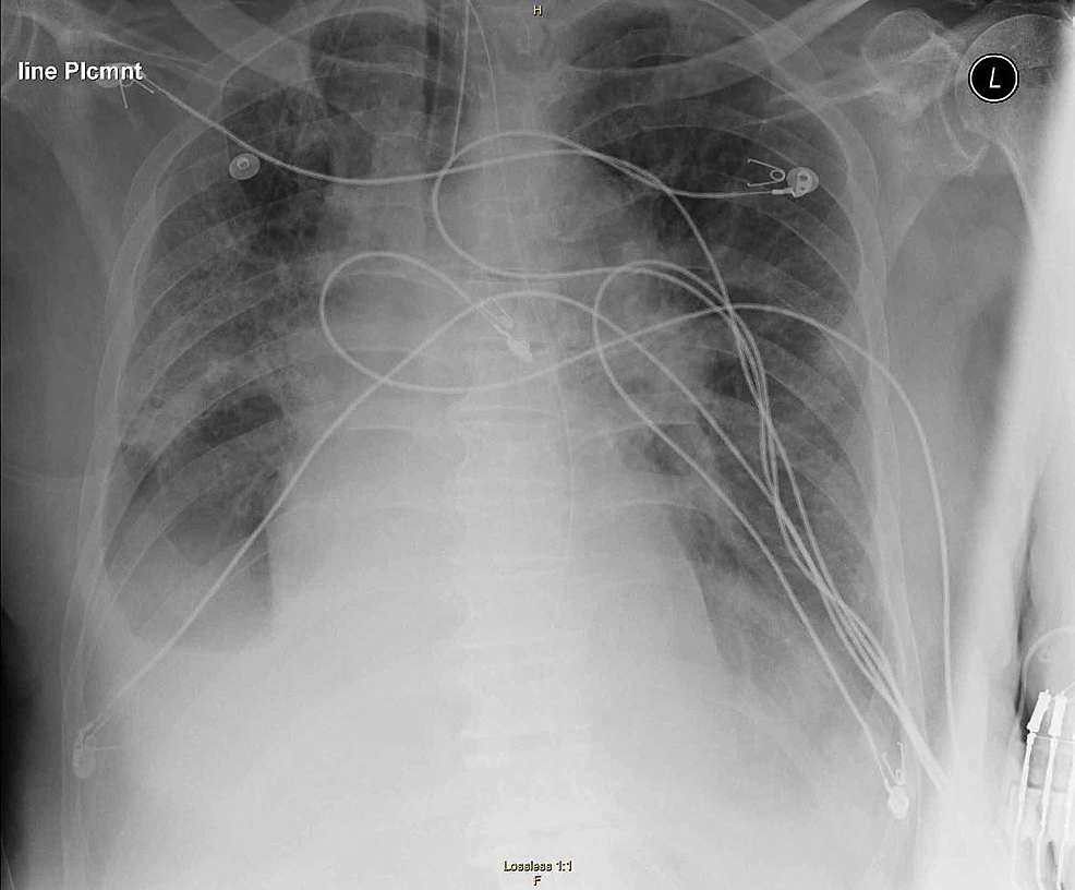 Chest-X-ray-shows-multifocal-airspace-opacities-and-“ground-glass-opacities”,-characteristic-signs-of-COVID-19-infection.
