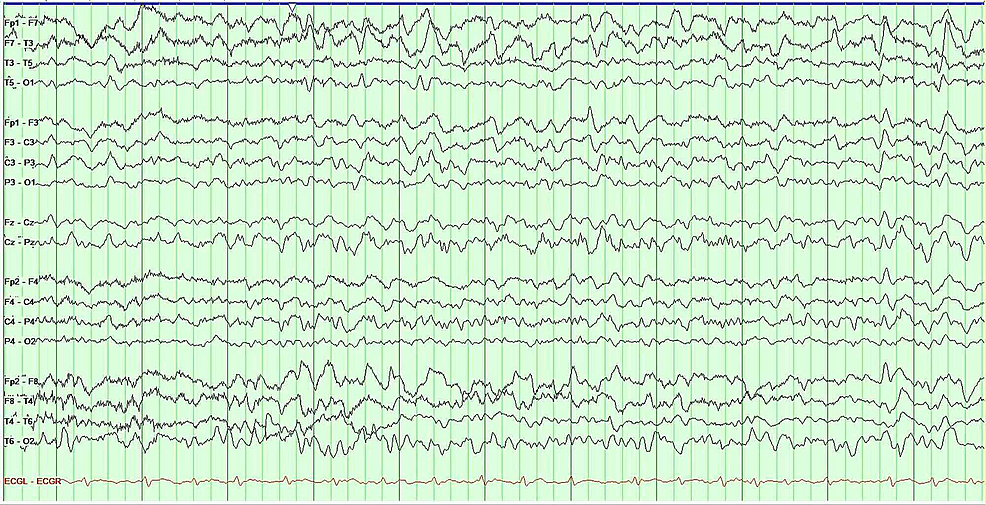 EEG-shows-diffuse-slowing-and-focal-slowing-sharply-contoured-waves-in-the-left-temporal-region.-These-findings-are-consistent-with-an-encephalopathy,-focal-left-temporal-lobe-dysfunction,-and-possible-epileptogenicity.--