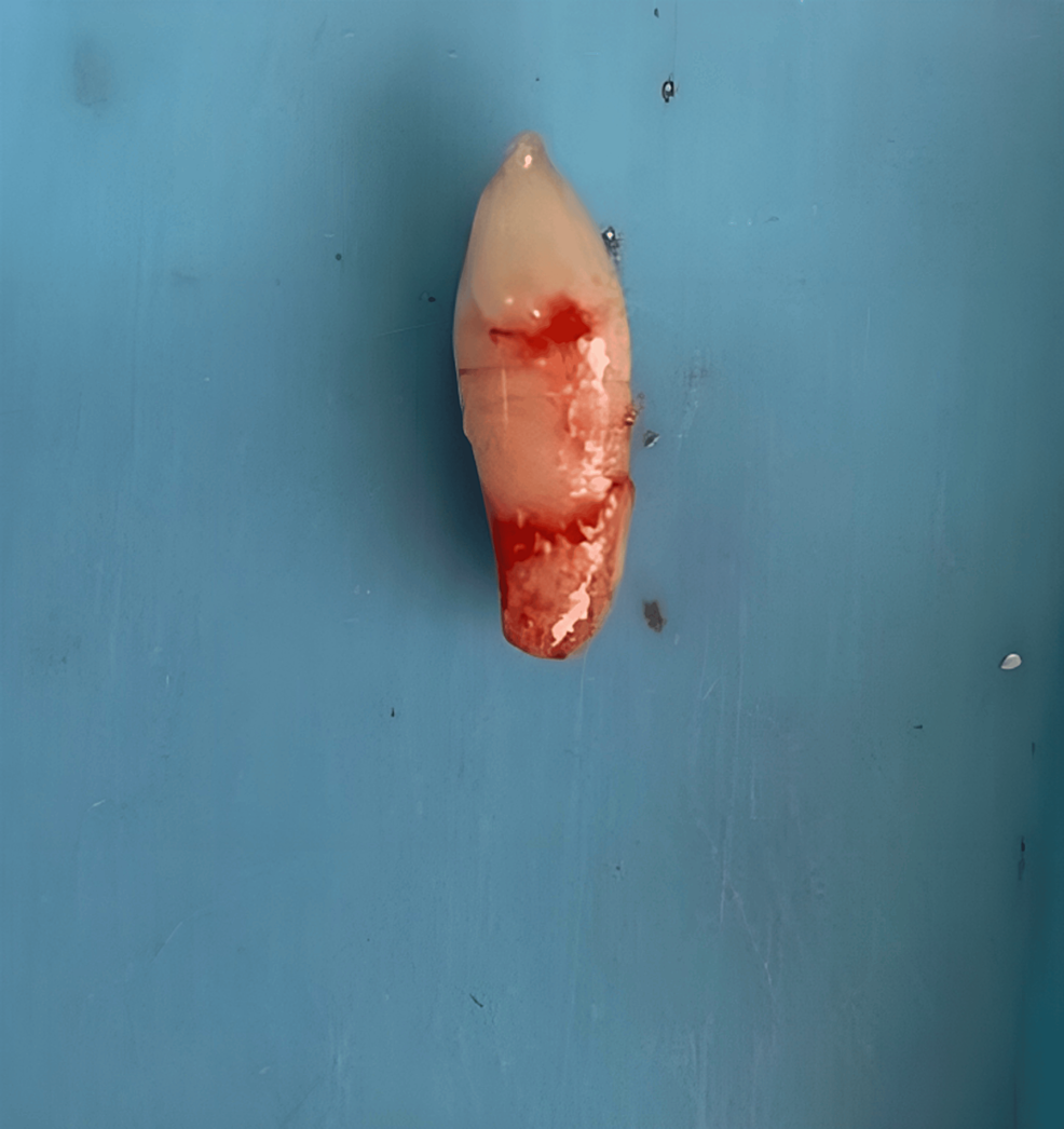 Anterior Maxillary Mesiodens Extraction in a Young Adult Male A Case