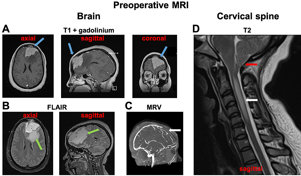 Cureus, Brainstem and Spinal Arachnoiditis Ossificans Associated With  Neurocysticercosis: A Case Report