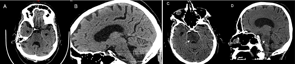 Initial-and-repeat-non-contrast-computed-tomography-(CT)-scans-of-the-brain