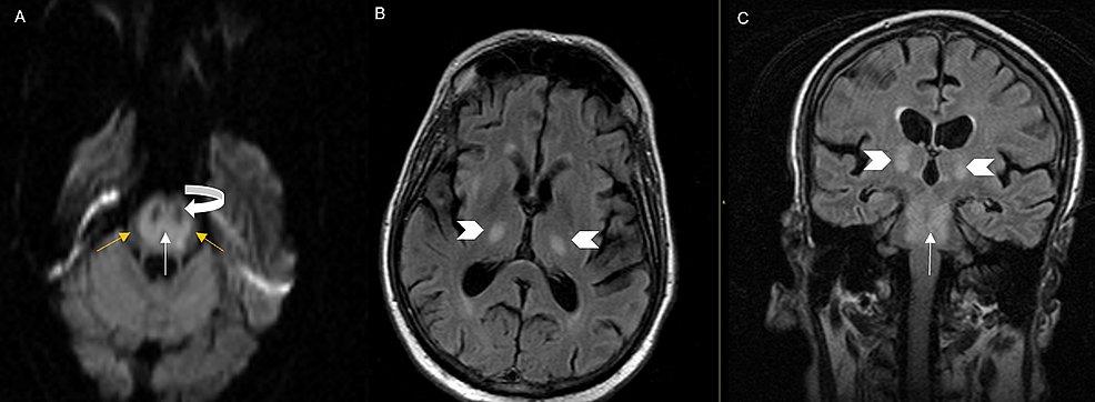 Axial-diffusion-weighted-(DWI)-magnetic-resonance-imaging-(MRI)