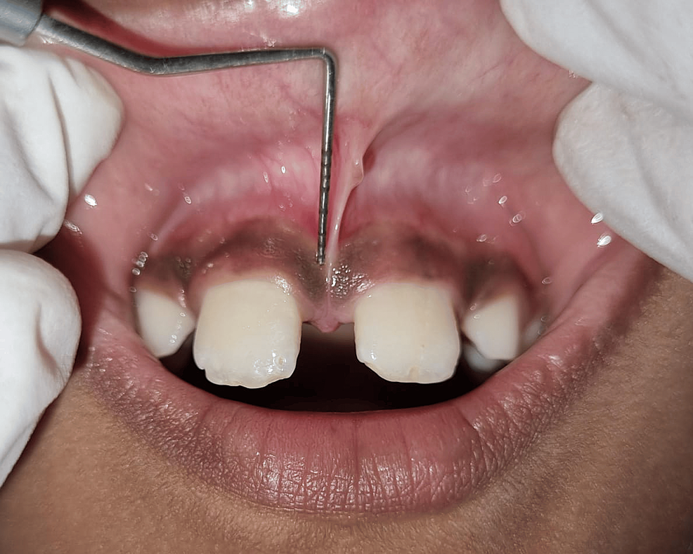 Pediatric High Labial Frenum Management Utilizing a Diode Laser for