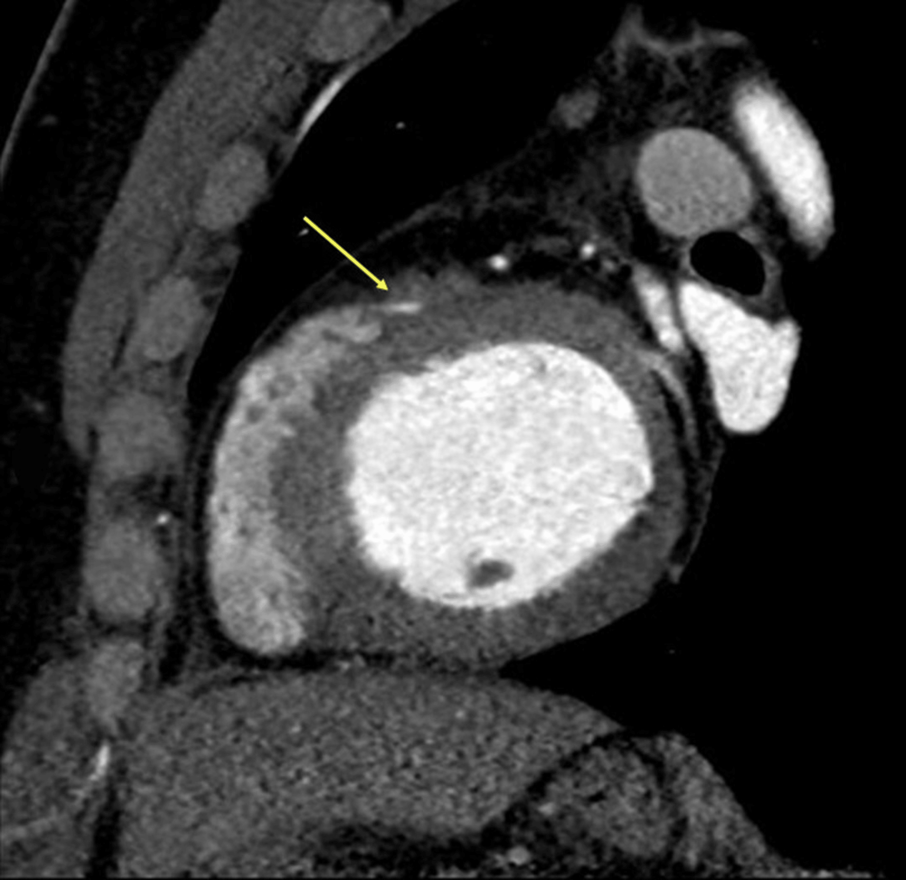 A Pictorial Essay Of Coronary Artery Anomalies On Coronary Ct 