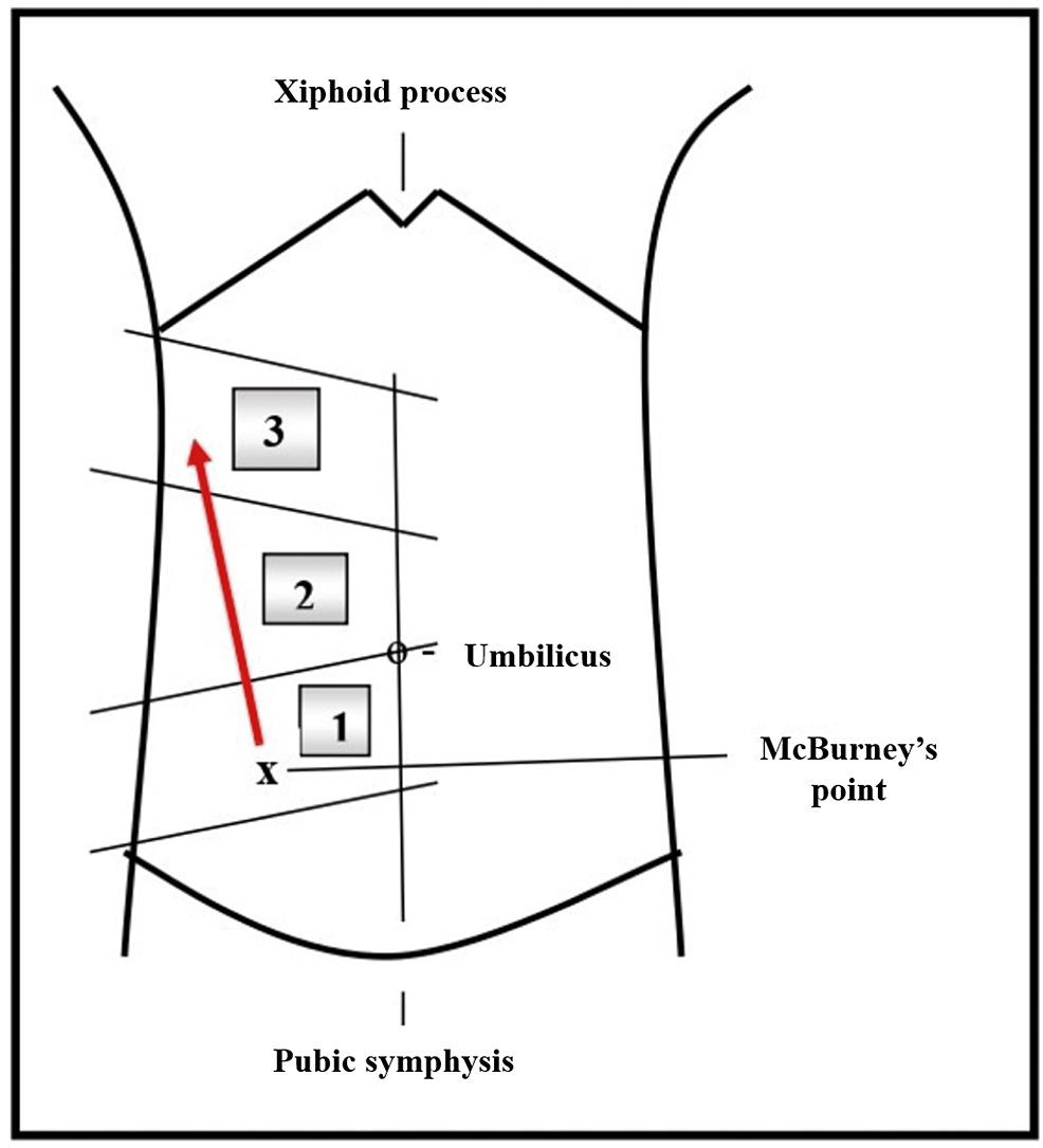 Early Diagnosis of Acute Appendicitis in the Second Trimester of ...