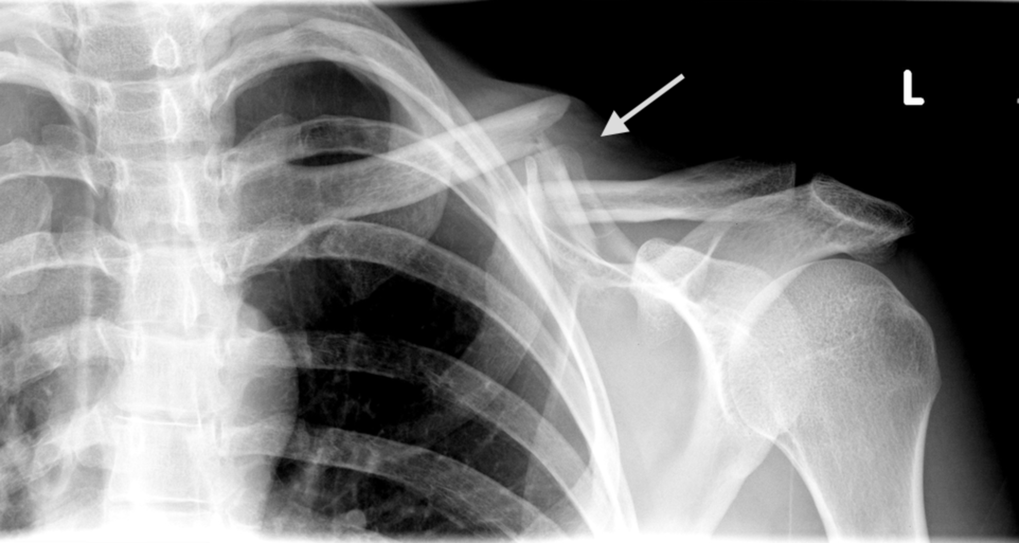 collarbone fracture