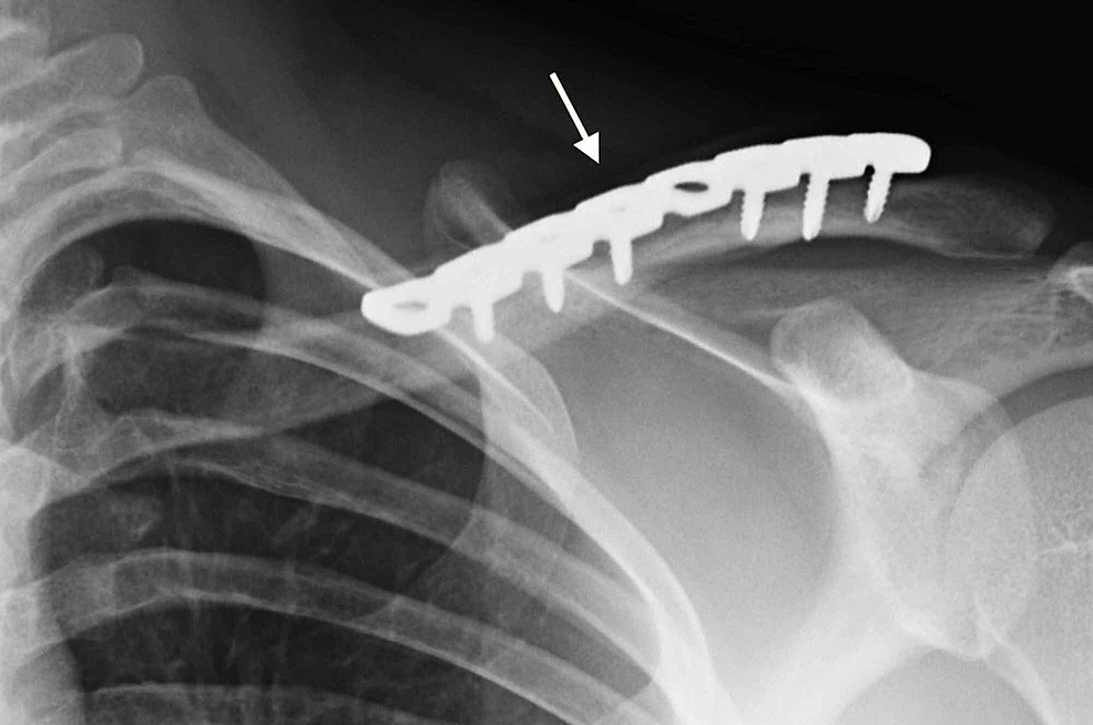 Cureus Improved Functional Outcomes Following Operative Treatment Of Midshaft Clavicle 0404