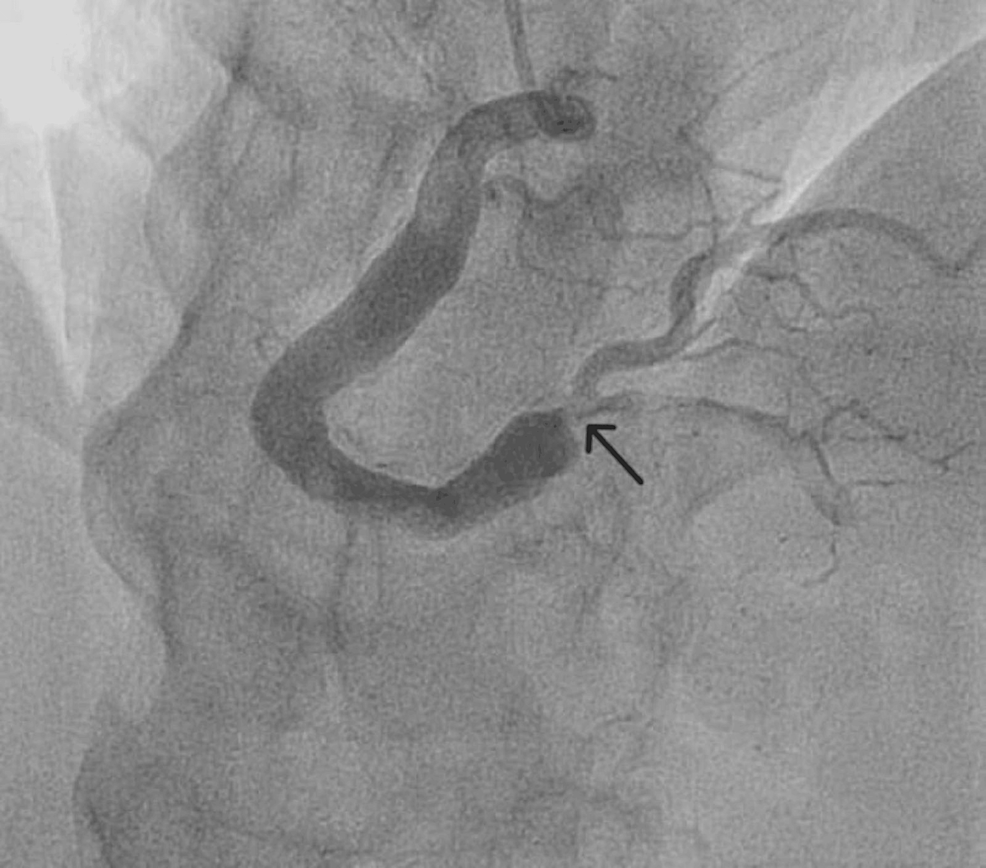 Coronary Artery Ectasia: Case Reports and Literature Review | Cureus