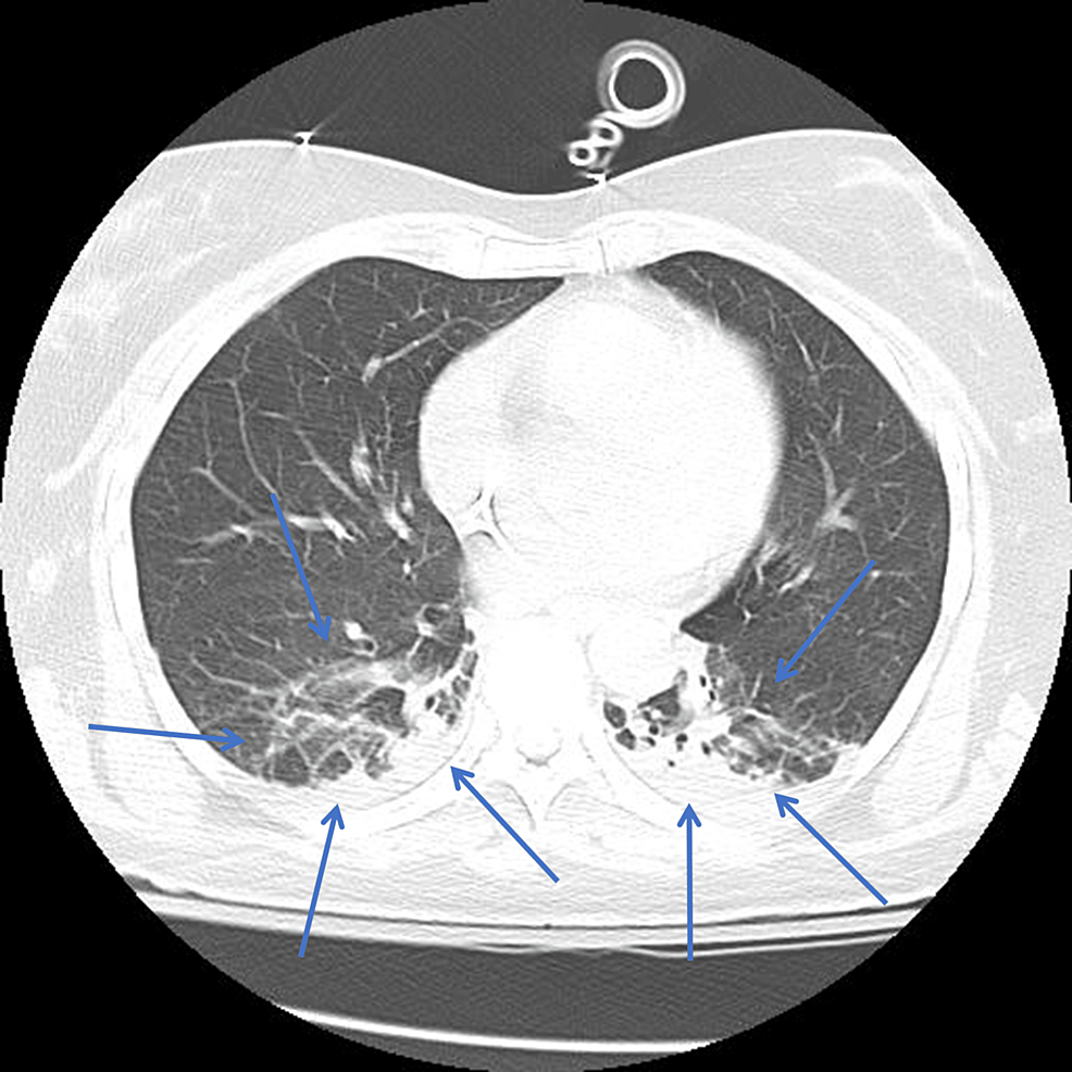 CTPA-showing-focal-infiltrates-in-the-lower-lung-lobes-(blue-arrows)