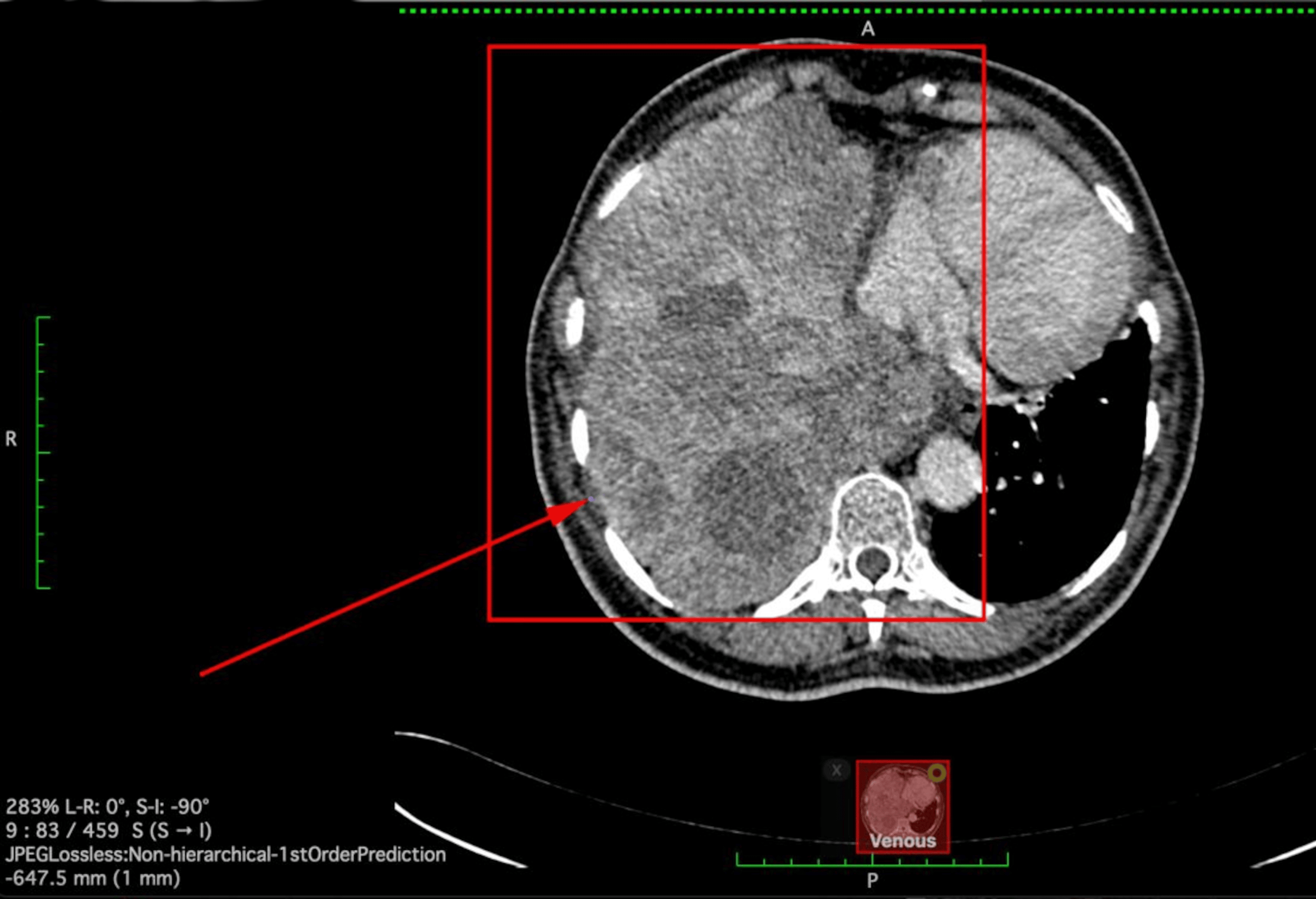 Cureus | Recurrent Hypoglycemia in a Non-diabetic Female: A Case Study ...