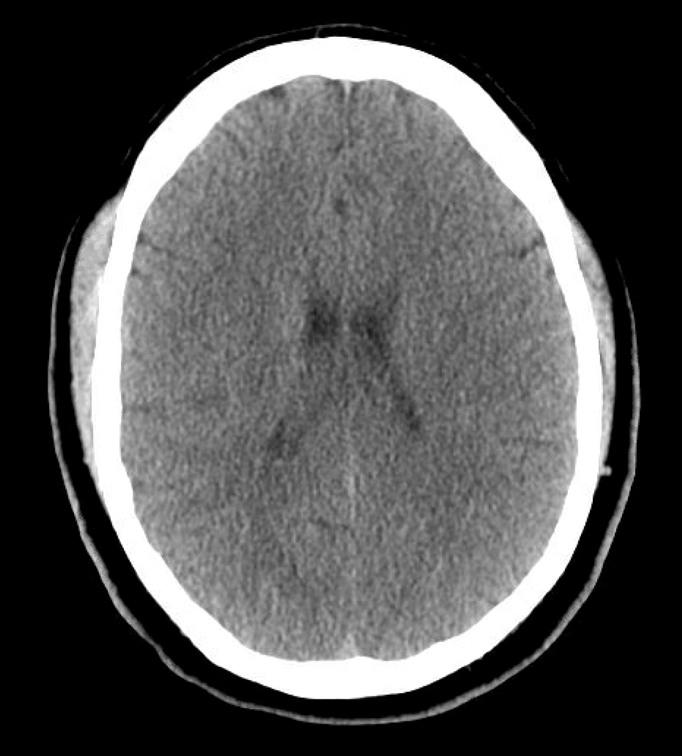 CT-head-without-contrast