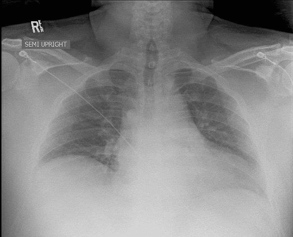 Chest-X-ray