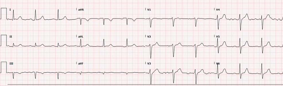 12-lead-ECG