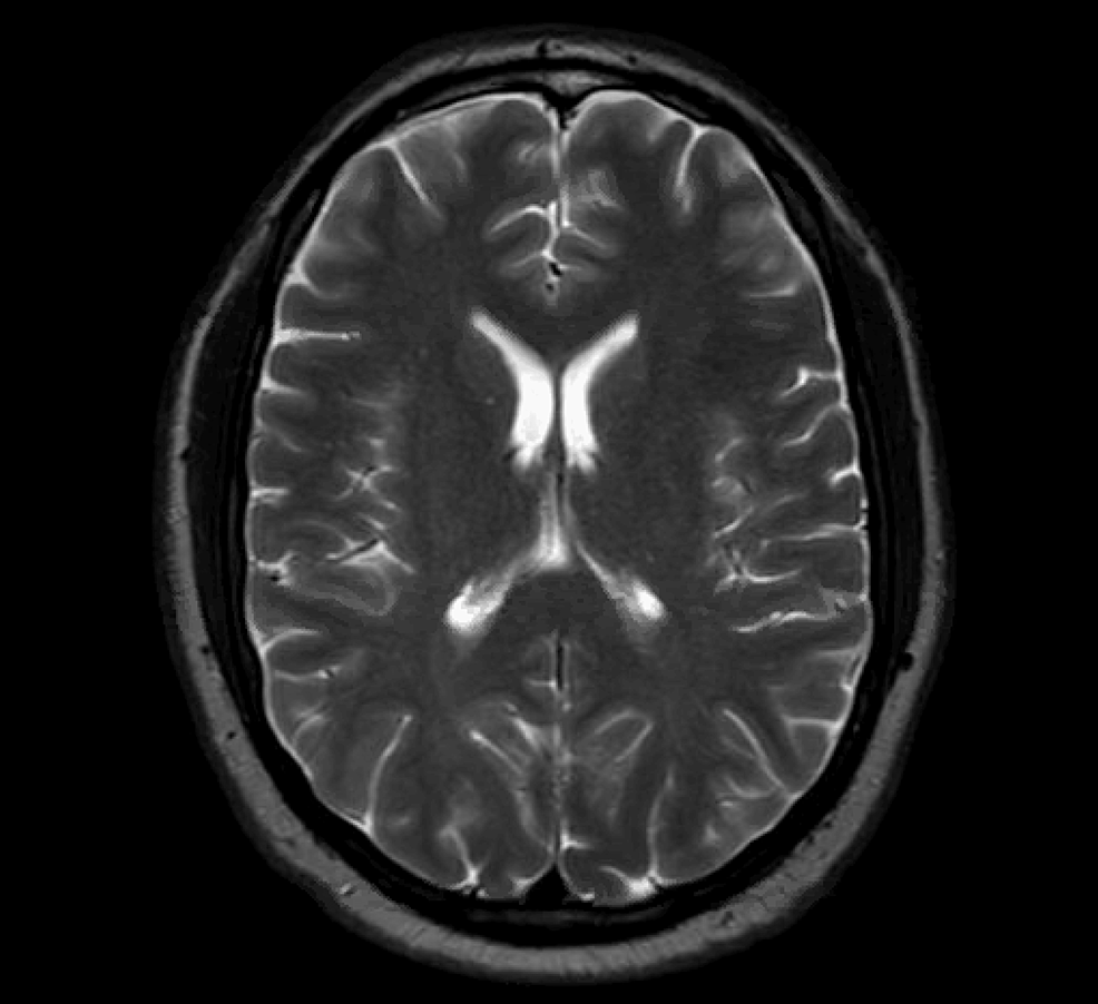 MRI-brain-without-contrast