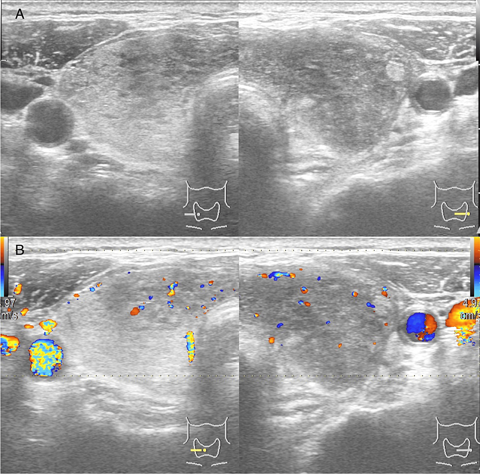 Thyroid-ultrasonography-and-Doppler-of-the-present-case