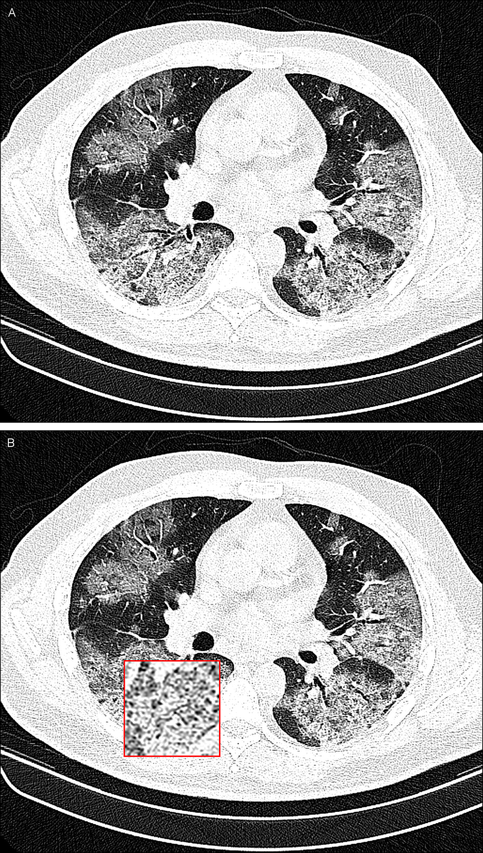 A-51-year-old-man-with-COVID-19-infection.