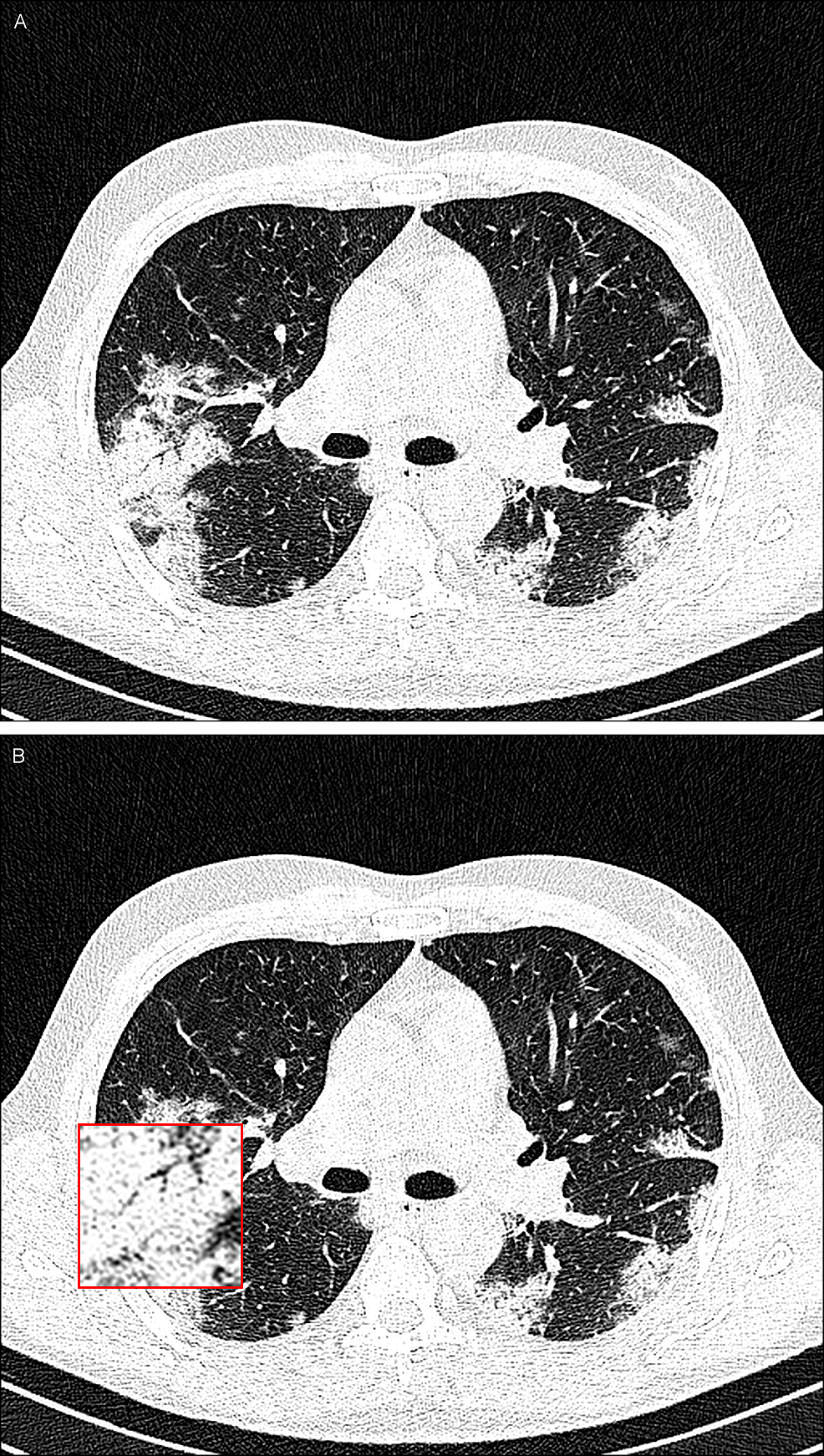 A-43-year-old-man-with-COVID-19.