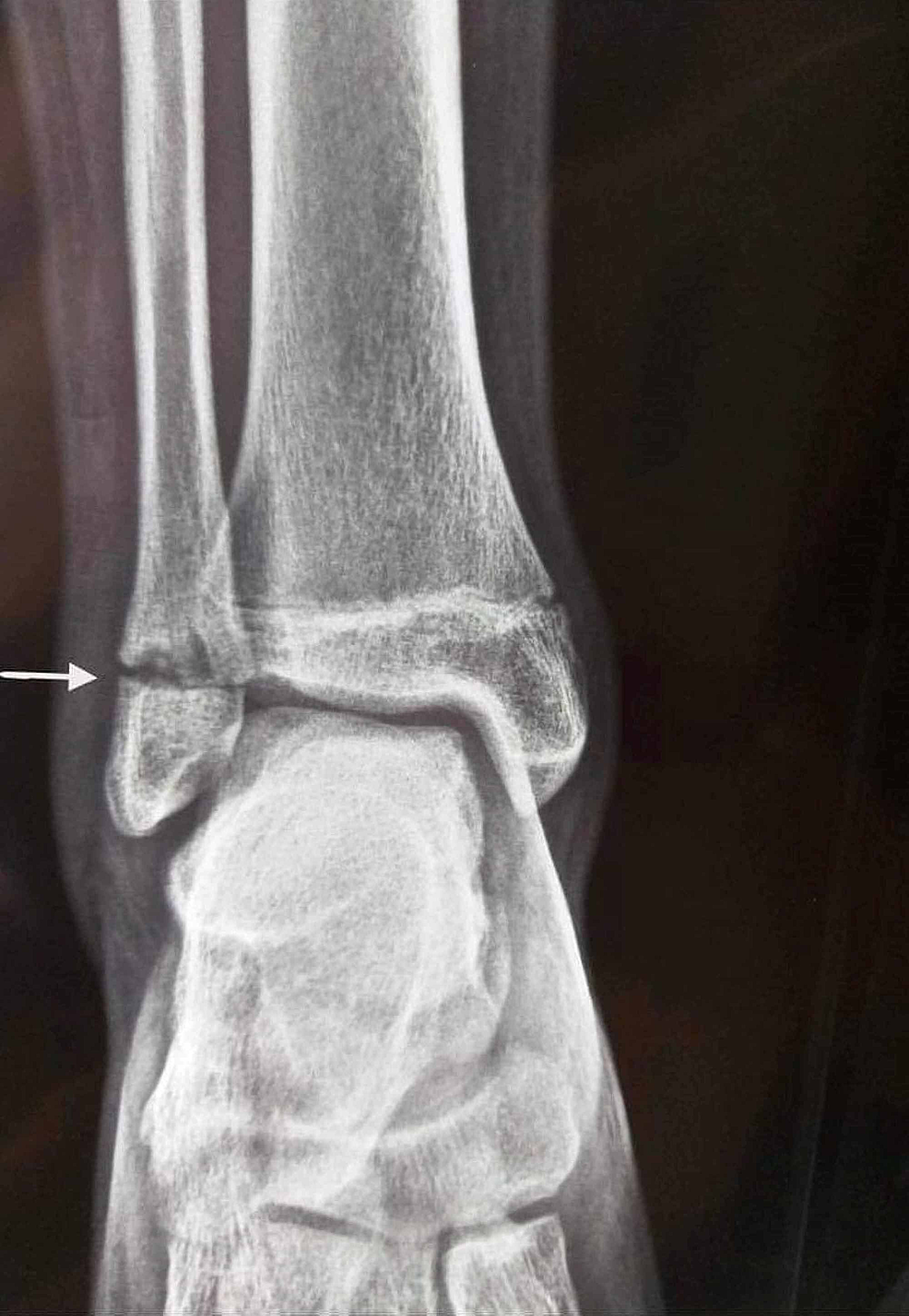 Cureus Pediatric Synovitis, Acne, Pustulosis, Hyperostosis, Osteitis (SAPHO) Syndrome