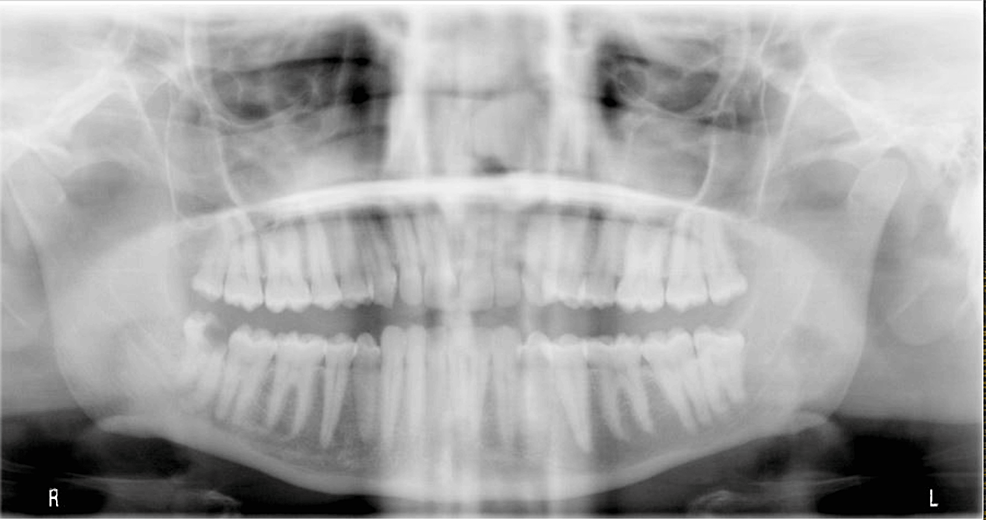 Cureus Idiopathic Intracranial Hypertension as a Differential