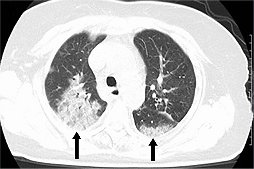 CT-of-the-chest-in-a-COVID-19-patient