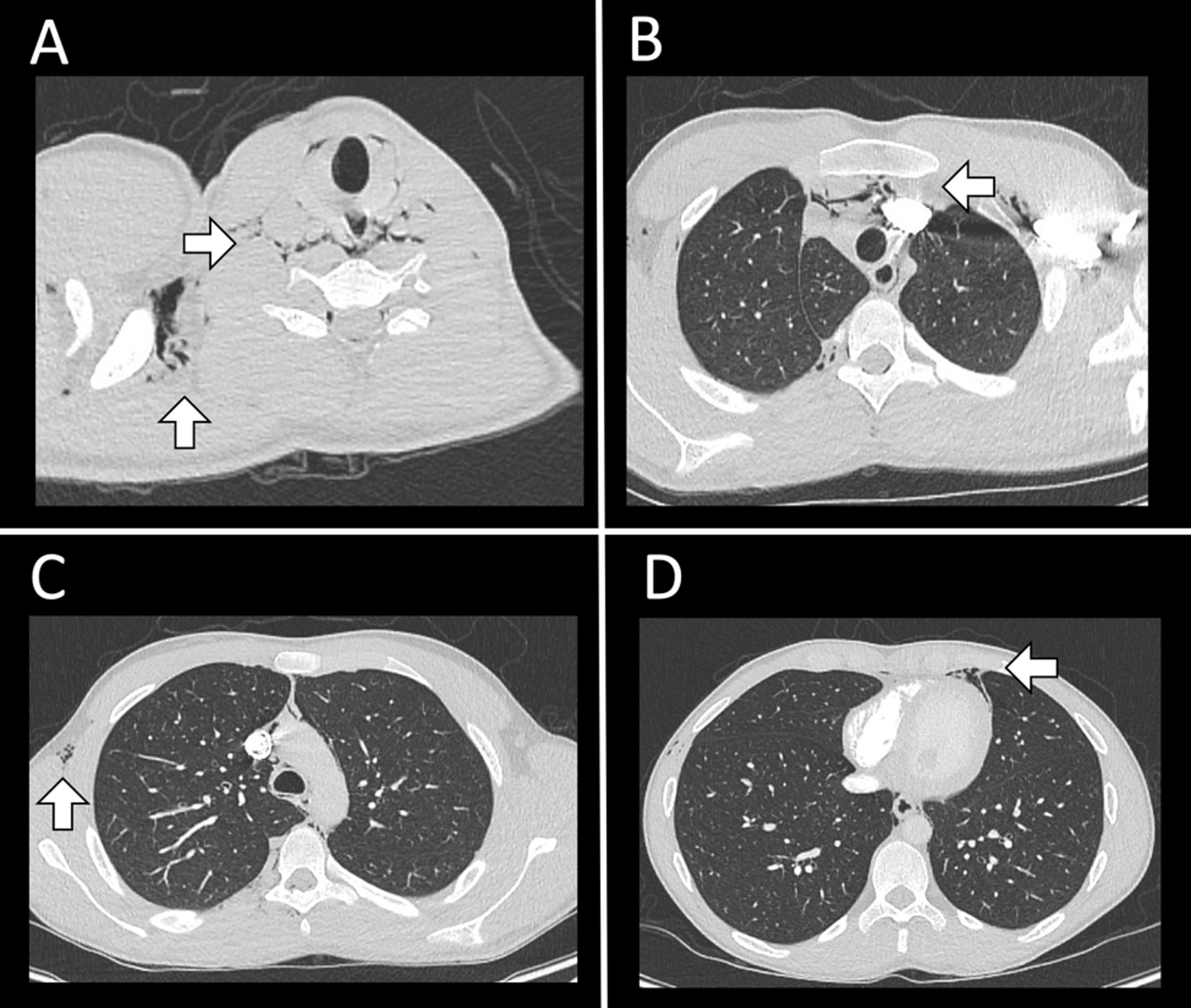 Cureus | Pneumorrhachis After an Upper Respiratory Infection: A Case ...