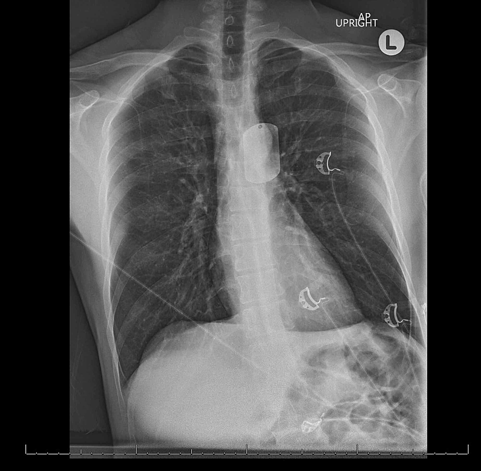 E-cigarette, or Vaping, Product Use-associated Lung Injury (EVALI): Acute  Lung Illness within Hours of Switching from Traditional to E-cigarettes |  Cureus