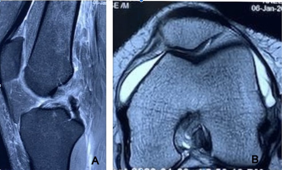 Patellofemoral Ligament Mri