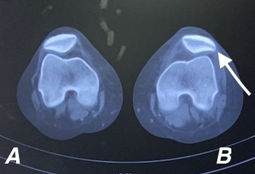 Cureus | Concurrent Anterior Cruciate Ligament And Medial ...