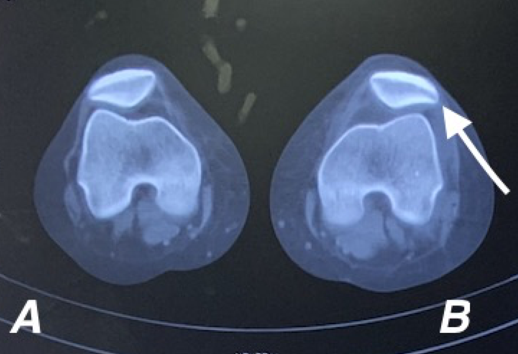 Cureus | Concurrent Anterior Cruciate Ligament And Medial ...