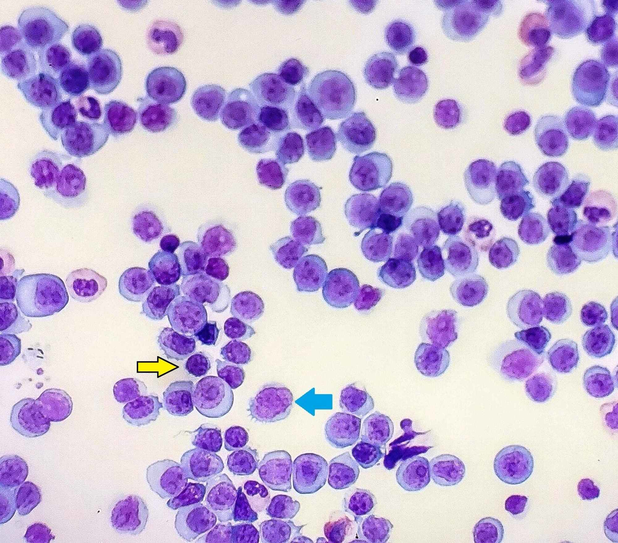 Tumor Lysis Syndrome