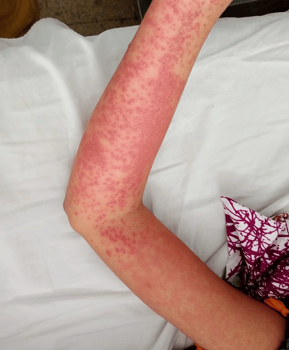 Metronidazole-Induced Drug Reaction with Eosinophilia and Systemic Symptoms (DRESS) Syndrome With Parvovirus B19 Reactivation: A Pediatric Case | Cureus Metronidazole-Induced Drug Reaction with Eosinophilia and Systemic Symptoms (DRESS) Syndrome With Parvovirus B19 Reactivation: A Pediatric Case | Cureus