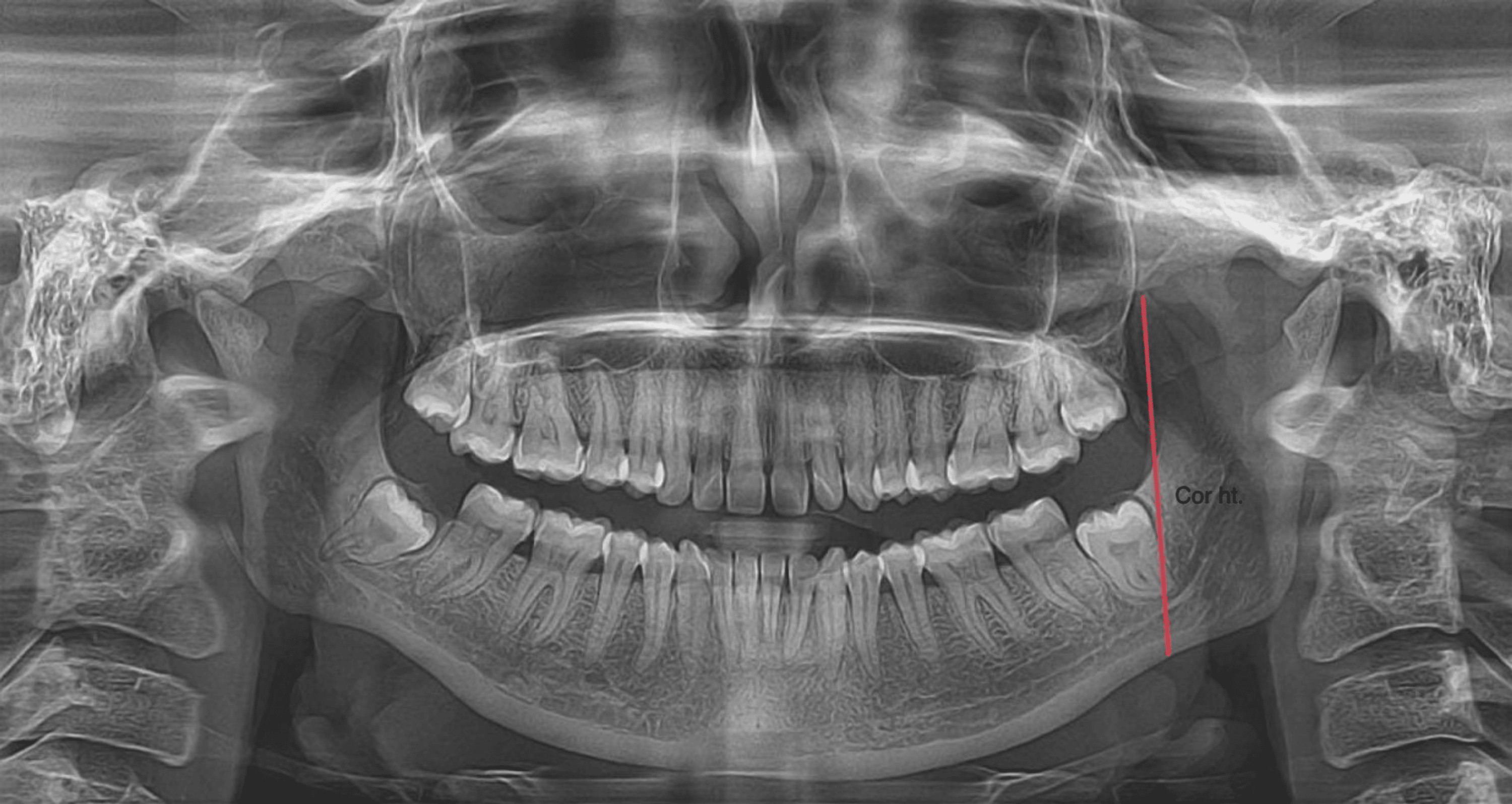 Evaluation Of Sexual Dimorphism Using Condylar And Coronoid Mandibular Parameters In 2030