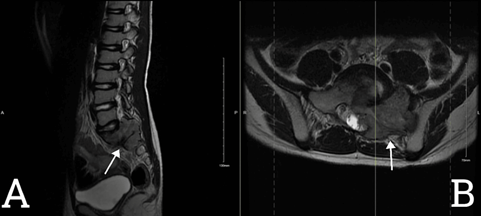 metastatic melanotic peripheral Intracranial metastasis from a malignant peripheral nerve sheath tumor in a  patient with neurofibromatosis type 1: A case study and literature review