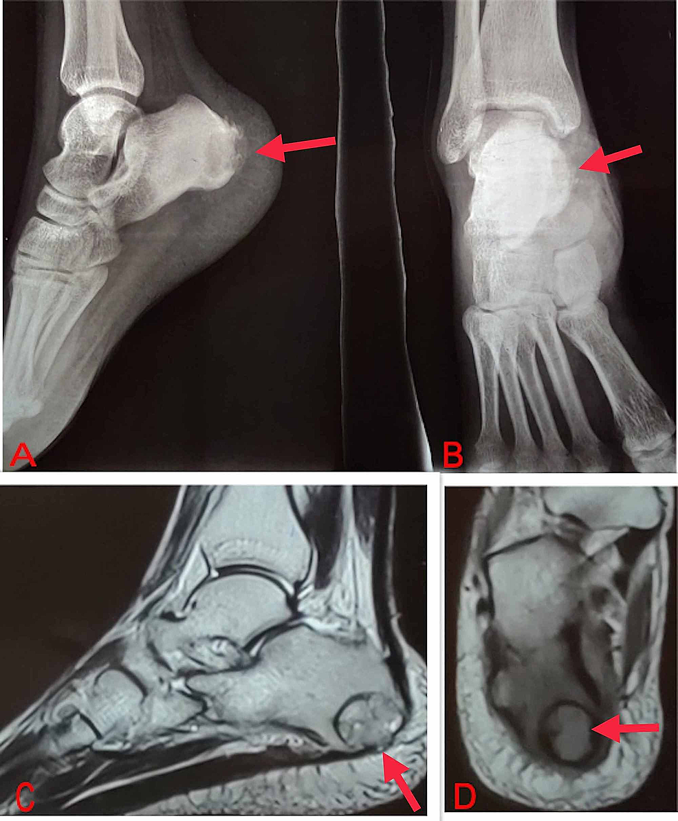Giant Cell Tumor Xray